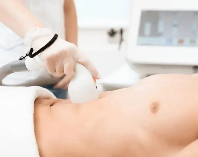 Triệt lông vùng bụng